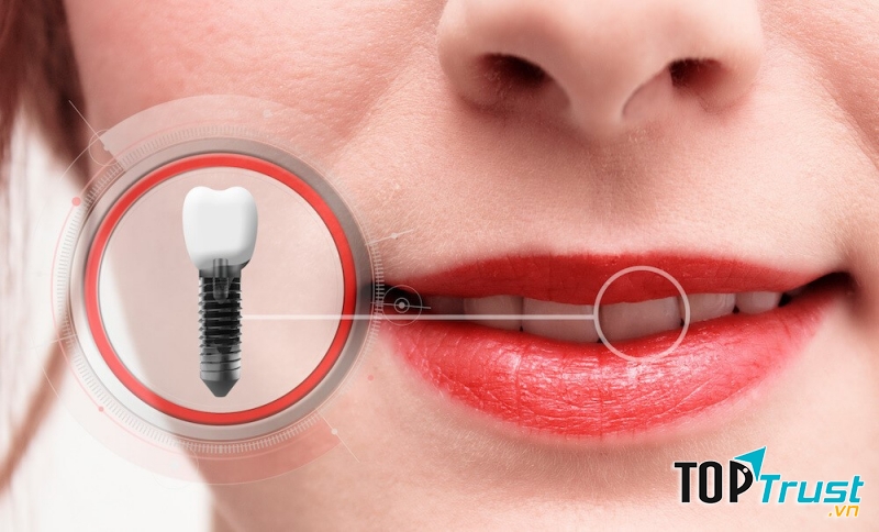 Quy trình trồng răng Implant chuẩn Quốc Tế