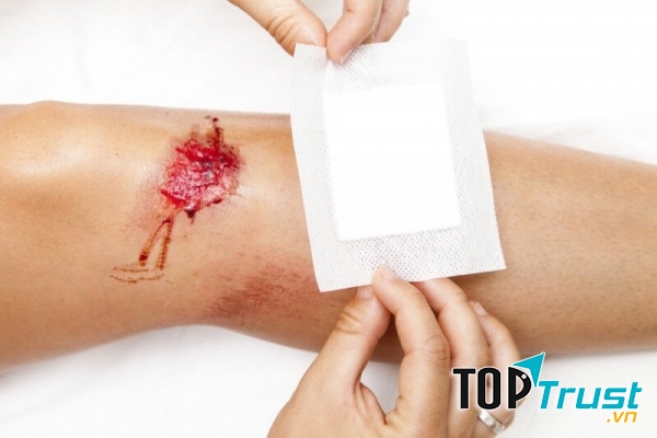 Sản phẩm cứu tinh cho vết thương hở, trầy xước