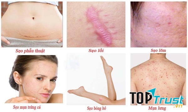 Sản phẩm đặc trị sẹo tốt nhất hiện nay
