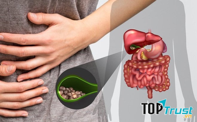 Sản phẩm hỗ trợ điều trị bệnh sỏi mật hiệu quả nhất