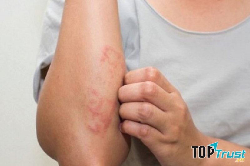 Sản phẩm hỗ trợ điều trị viêm da cơ địa tốt nhất hiện nay