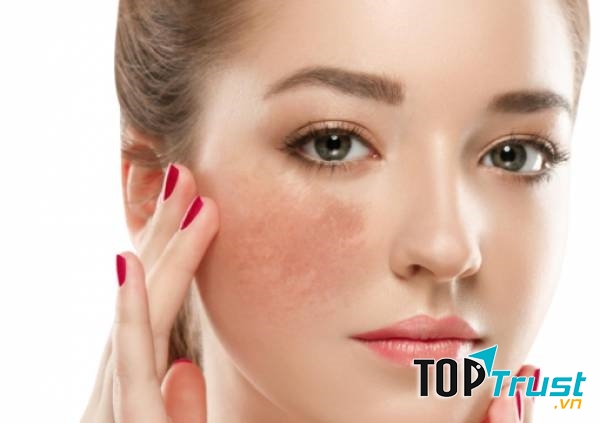 Sản phẩm huyết thanh trị nám hiệu quả nhất cho chị em