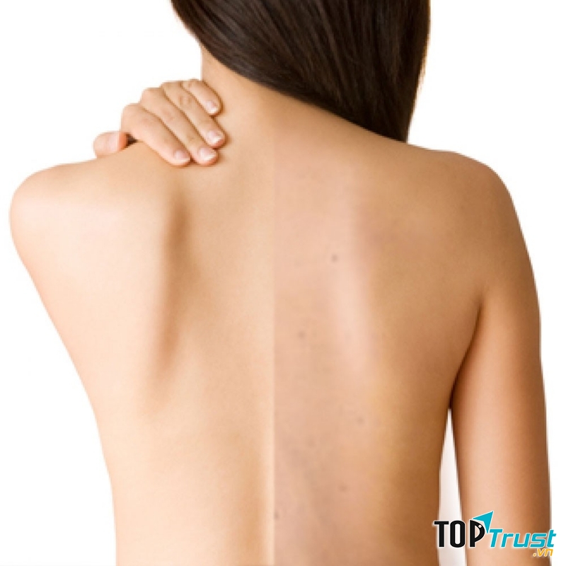 Sản phẩm trị mụn ở lưng tốt nhất hiện nay