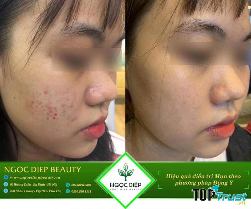 Spa trị mụn bằng phương pháp Đông Y uy tín và chất lượng nhất Hà Nội