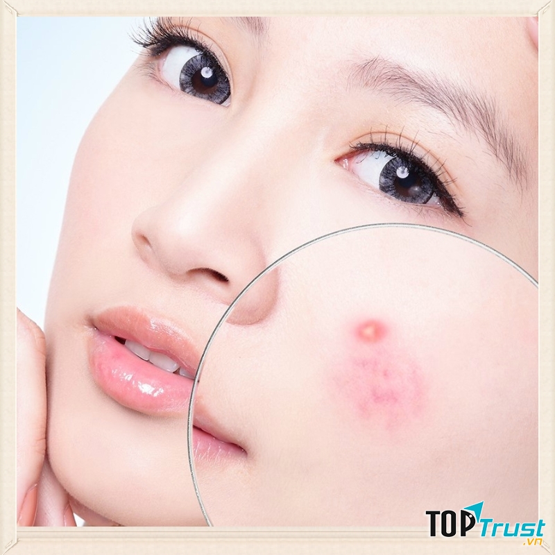 Spa trị mụn hiệu quả nhất Ninh Bình