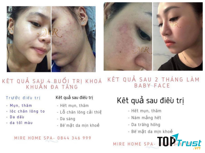 Spa trị mụn hiệu quả nhất ở Nha Trang