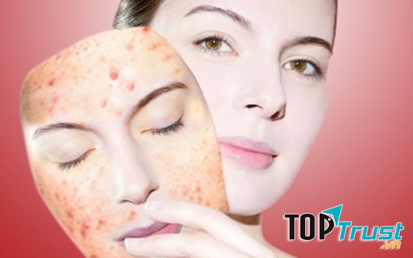 Spa trị mụn hiệu quả nhất Thanh Hóa