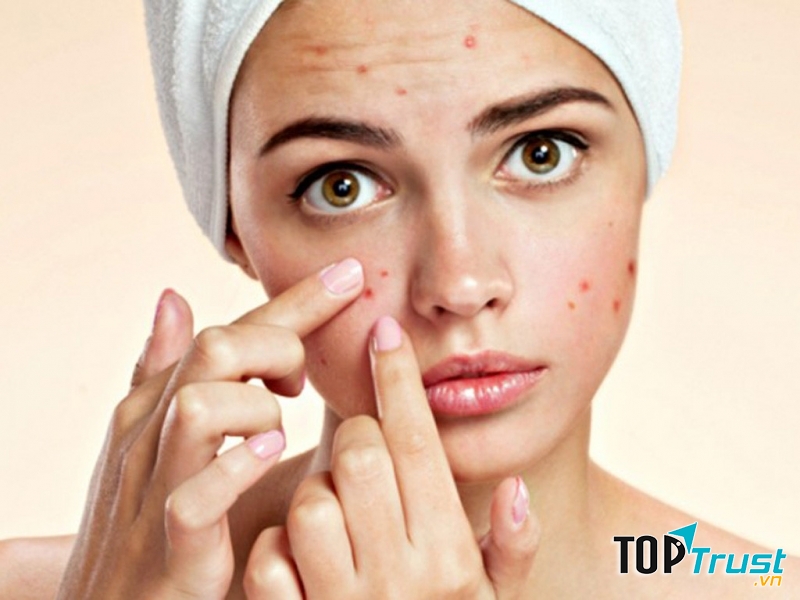 Spa trị mụn hiệu quả nhất TP. Bà Rịa