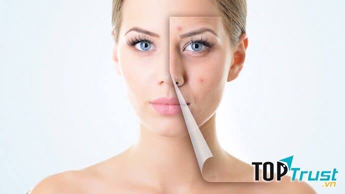 Spa trị mụn hiệu quả nhất Vũng Tàu