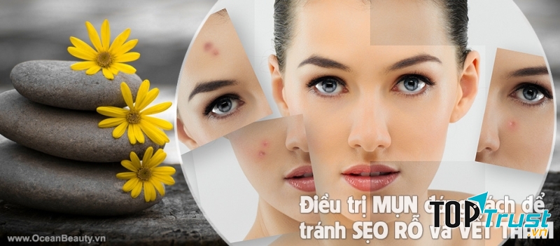 Spa trị mụn tốt nhất ở Hà Nội