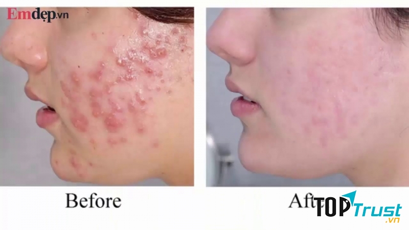 Spa trị mụn tốt nhất tại Kon Tum