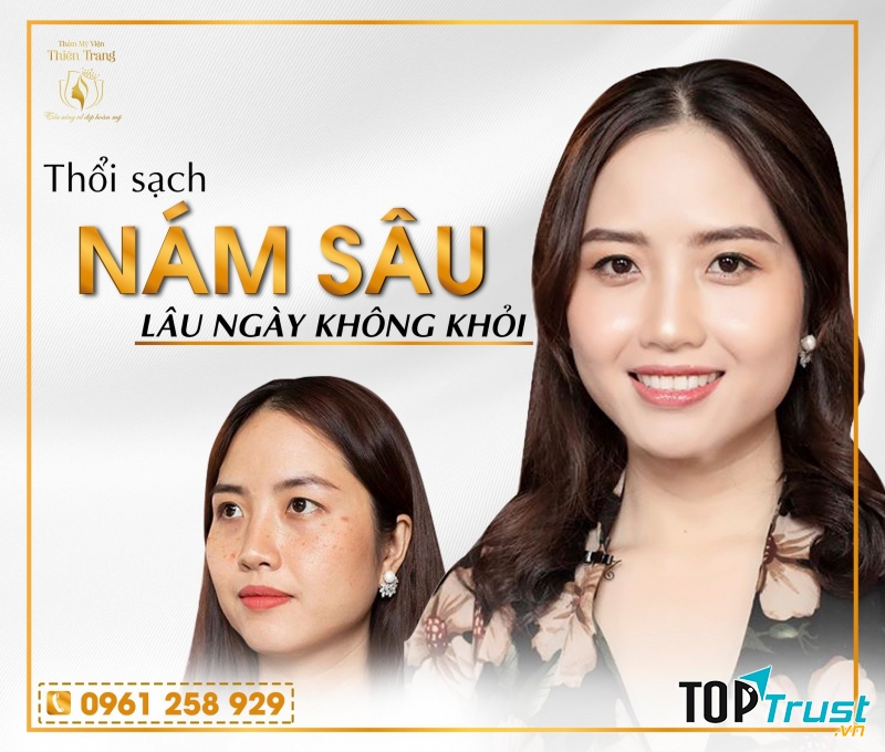 Spa trị nám hiệu quả nhất ở Hà Nội
