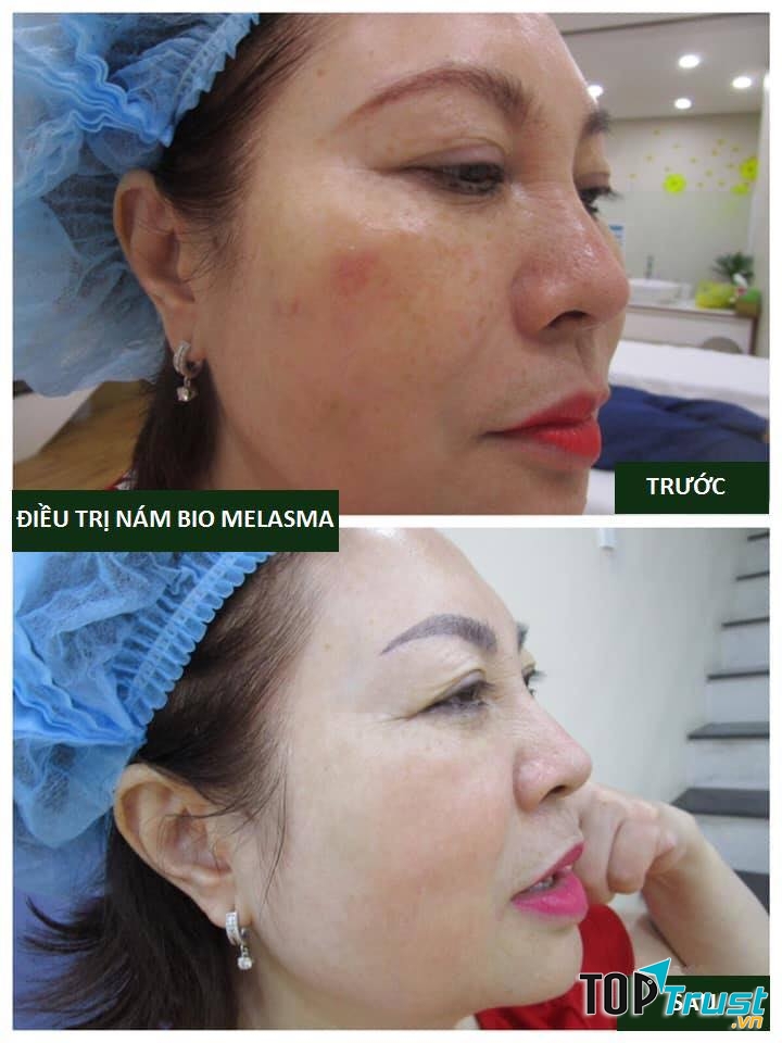 Spa trị nám hiệu quả nhất quận 5, TP. HCM