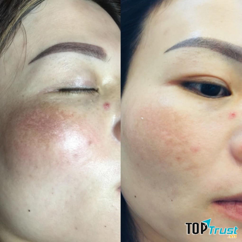 Spa trị nám hiệu quả nhất quận 7, TP. HCM