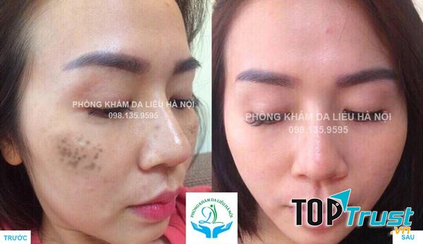 Spa trị nám hiệu quả nhất quận Cầu Giấy, Hà Nội