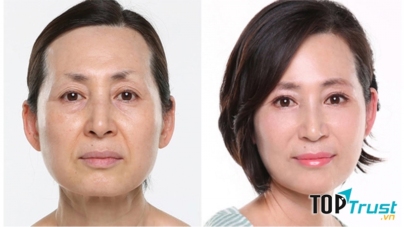 Spa trị nám tốt nhất Bắc Ninh