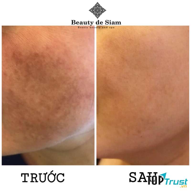 Spa trị nám tốt nhất Bến Tre