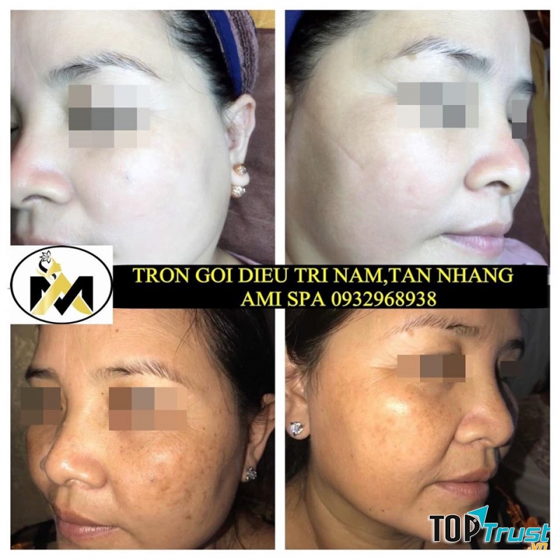 Spa trị nám tốt nhất Cần Thơ