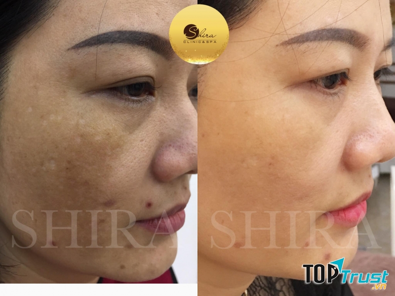 Spa trị nám tốt nhất Hải Dương