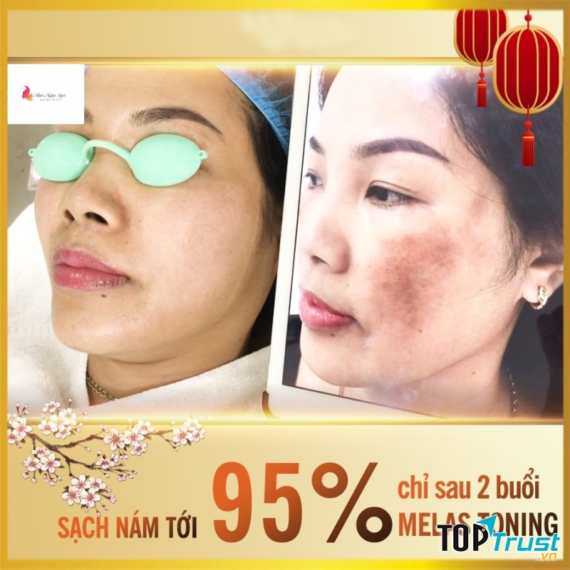 Spa trị nám tốt nhất Huế