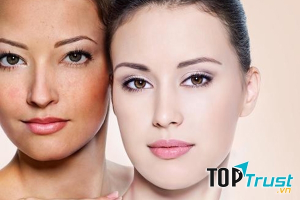 Spa trị nám tốt nhất tại Bắc Giang