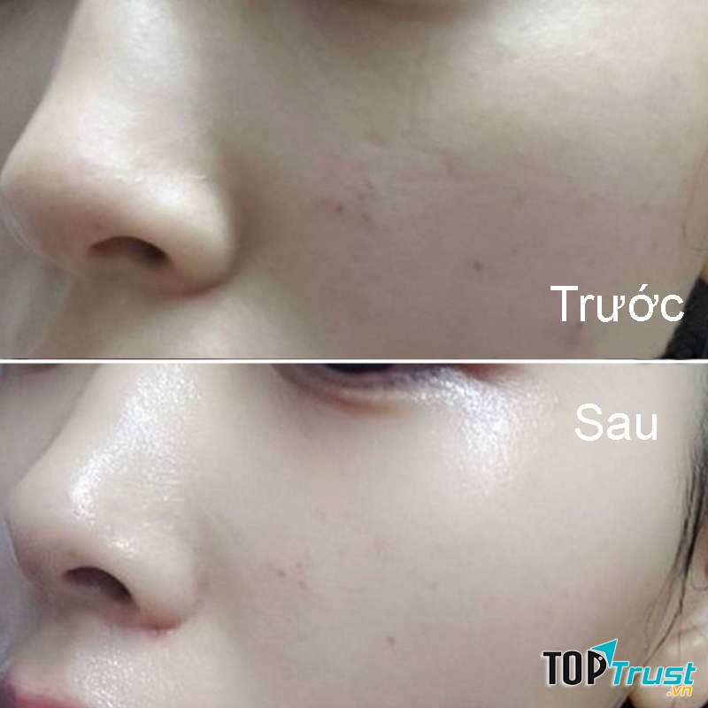 Spa trị nám tốt nhất Thái Nguyên