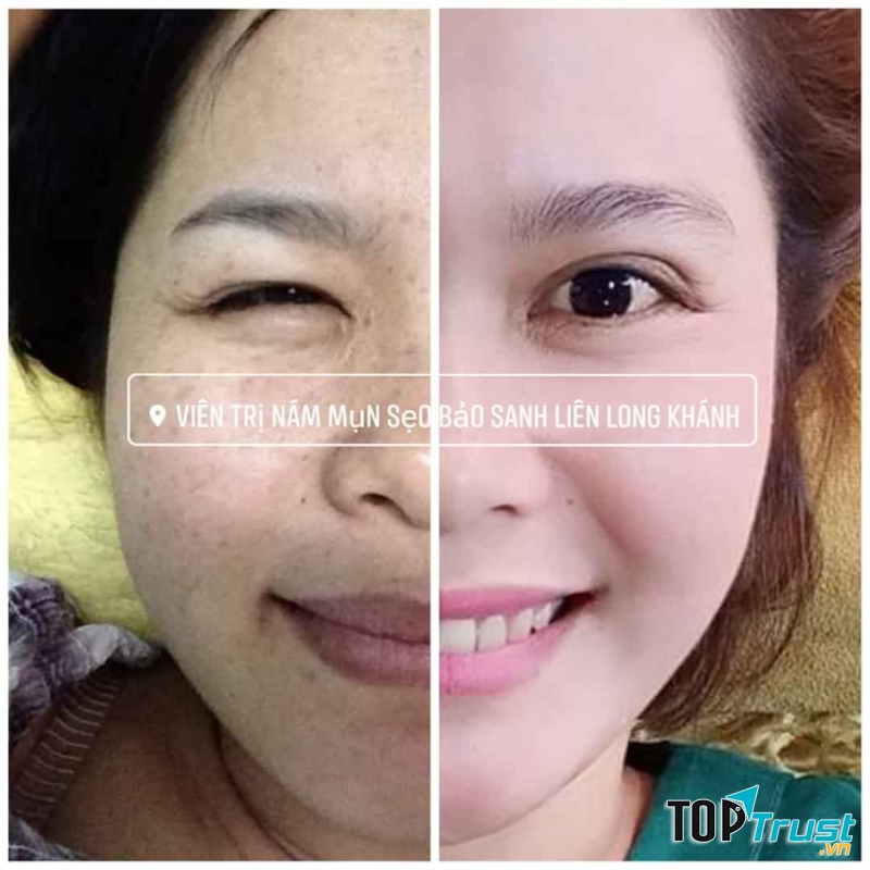 Spa trị nám tốt nhất TP. Long Khánh, Đồng Nai