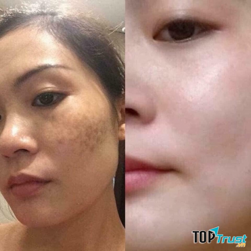 Spa trị nám tốt nhất Tuyên Quang