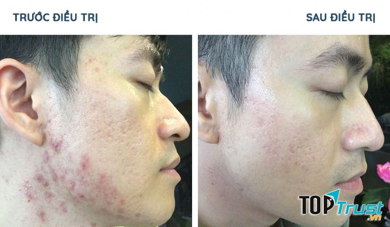 Spa trị sẹo rỗ do mụn tốt nhất Quảng Ngãi