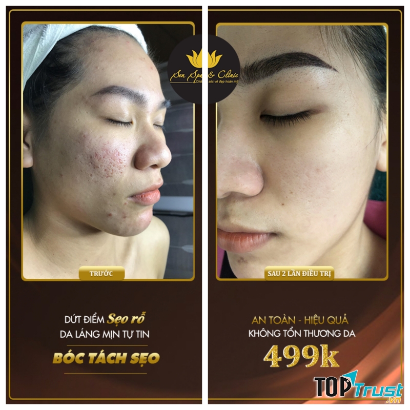 Spa trị sẹo rỗ do mụn uy tín nhất tại Cần Thơ