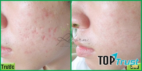 Spa trị sẹo rỗ do mụn uy tín nhất tại Hà Nội