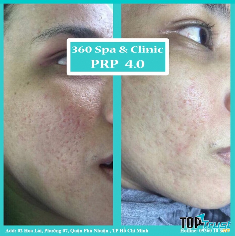 Spa trị sẹo rỗ do mụn uy tín nhất tại Hải Phòng