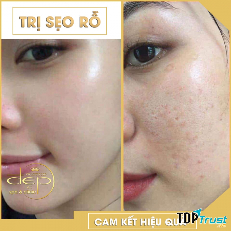 Spa trị sẹo rỗ do mụn uy tín nhất tại Nha Trang