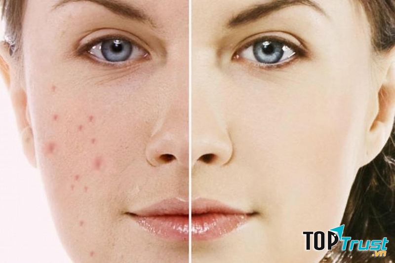 Thẩm mỹ viện trị mụn uy tín nhất ở TPHCM