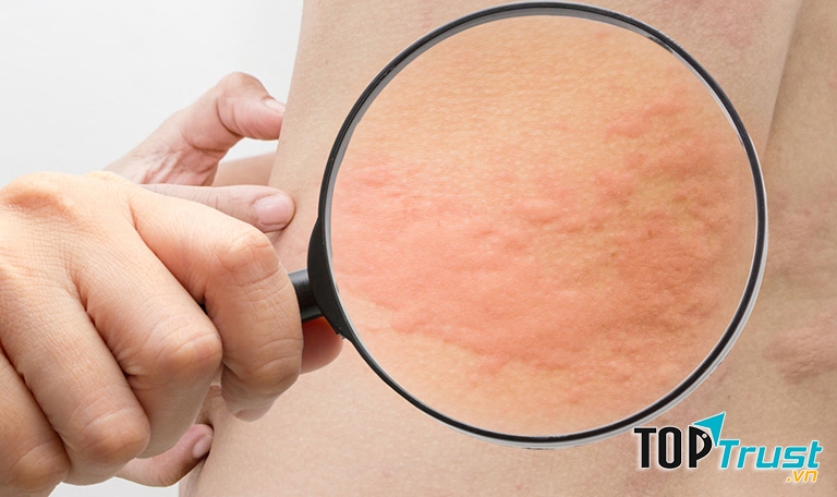 Thực phẩm chức năng hỗ trợ điều trị mề đay hiệu quả nhất