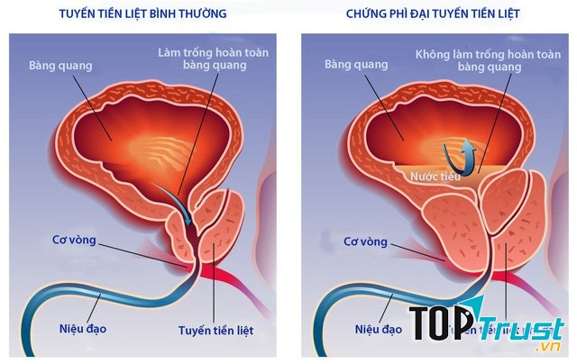 Thực phẩm chức năng hỗ trợ điều trị phì đại tiền liệt tuyến tốt nhất