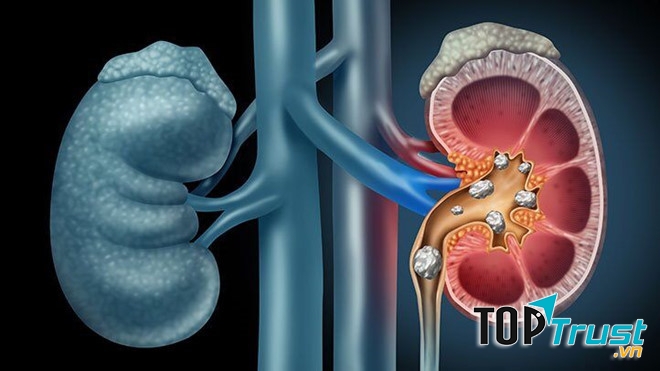 Thực phẩm chức năng hỗ trợ điều trị sỏi thận hiệu quả nhất hiện nay