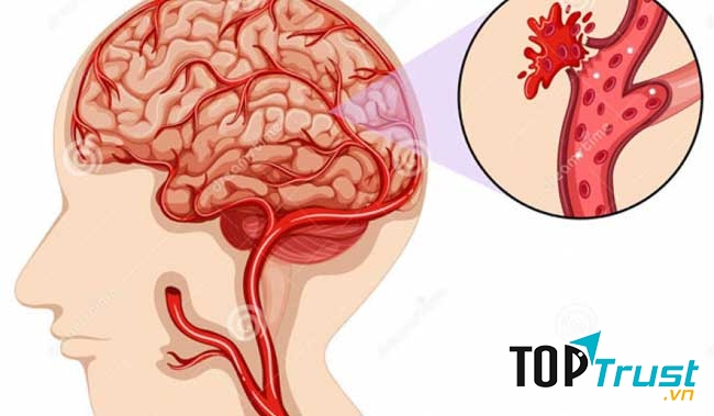 Thực phẩm chức năng hỗ trợ điều trị tai biến mạch máu não tốt nhất hiện nay