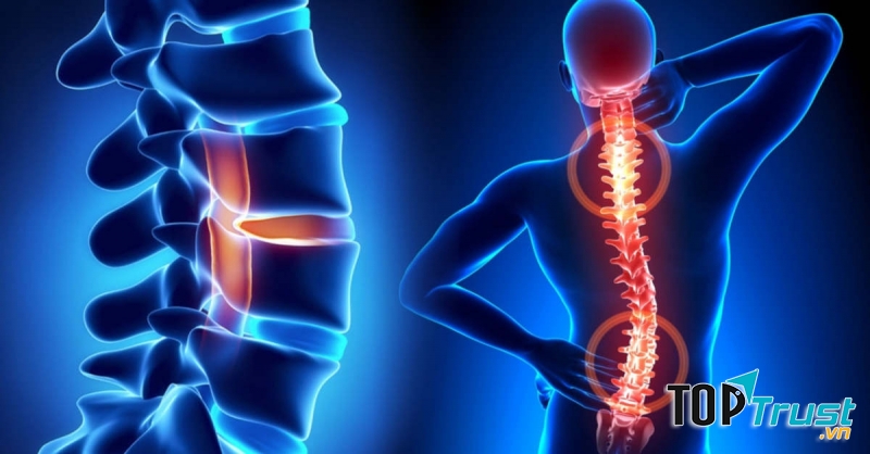 Thực phẩm chức năng hỗ trợ điều trị thoái hóa đốt sống hiệu quả nhất