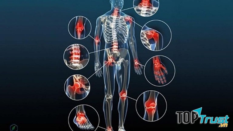 Thực phẩm chức năng hỗ trợ điều trị thoái hóa khớp tốt nhất hiện nay