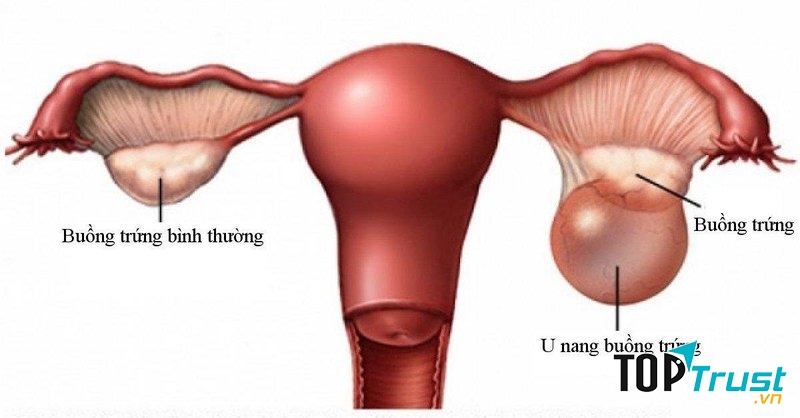 Thực phẩm chức năng hỗ trợ điều trị u nang buồng trứng hiệu quả nhất