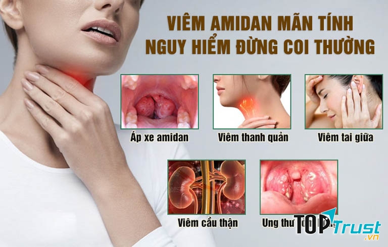 Thực phẩm chức năng hỗ trợ điều trị viêm amidan tốt nhất hiện nay