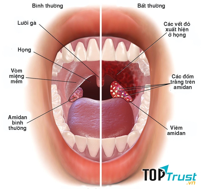 Thực phẩm chức năng hỗ trợ điều trị viêm họng tốt nhất hiện nay