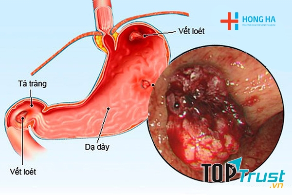 Thực phẩm chức năng hỗ trợ điều trị viêm loét dạ dày hiệu quả nhất