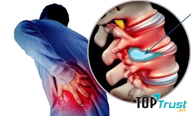 Thực phẩm chức năng tốt nhất cho người thoát vị đĩa đệm