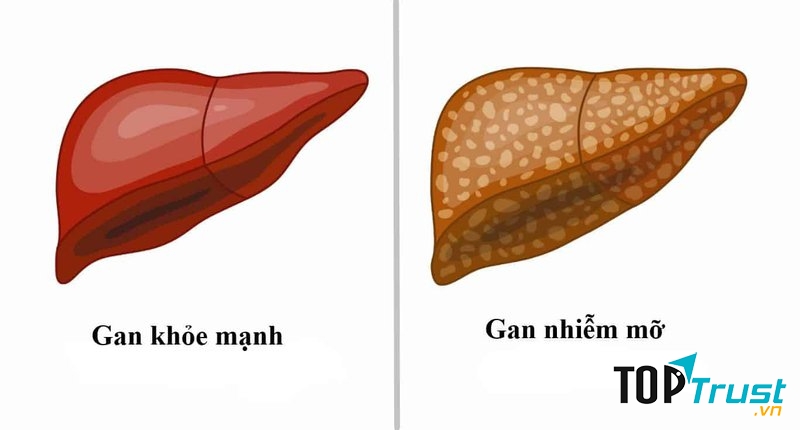 Thực phẩm chức năng tốt nhất hỗ trợ điều trị gan nhiễm mỡ
