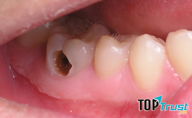 Thực phẩm dễ gây sâu răng bạn nên biết