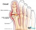 Cách chữa bệnh gút hiệu quả nhất