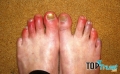 Cách chữa cước chân nhanh nhất