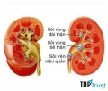 Dấu hiệu bệnh sỏi thận bạn nên biết